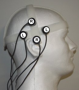 The Shakti Coils over the right temporal lobe.